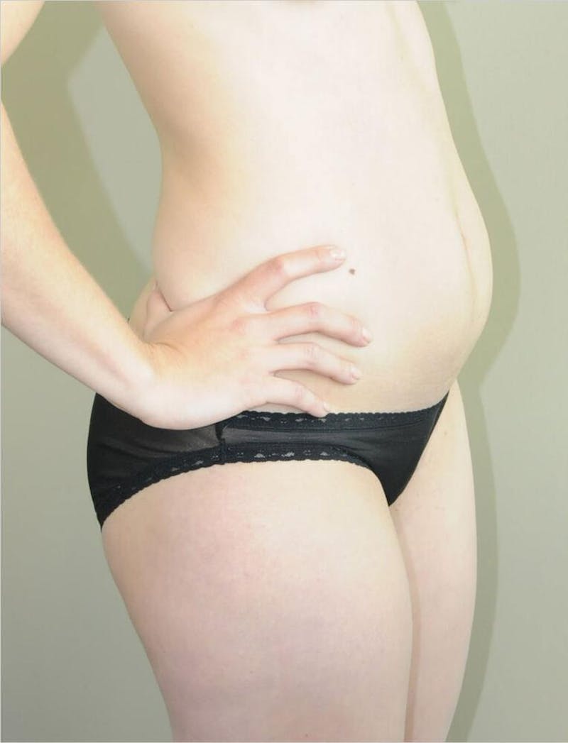 Liposuction Before & After Gallery - Patient 191614393 - Image 3