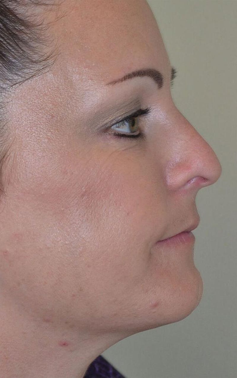 Lip Augmentation Before & After Gallery - Patient 191558229 - Image 6