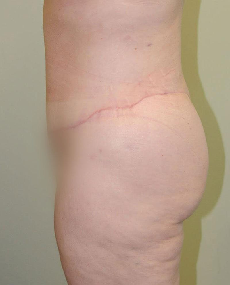 Tummy Tuck Before & After Gallery - Patient 191563238 - Image 6