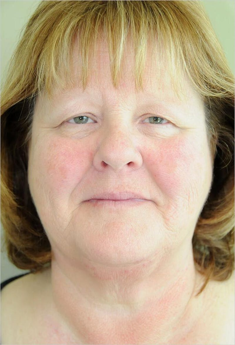 Face and Neck Lifts Before & After Gallery - Patient 191668478 - Image 1