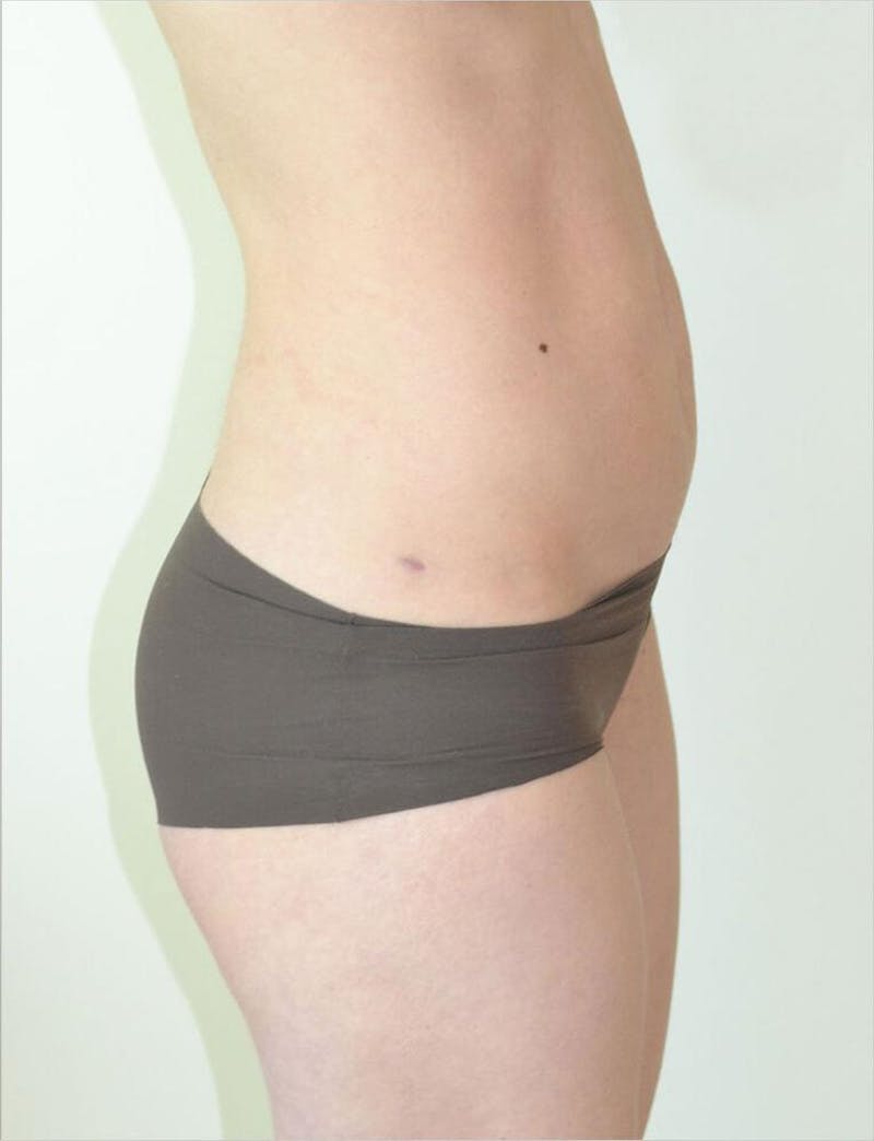Liposuction Before & After Gallery - Patient 191614393 - Image 4