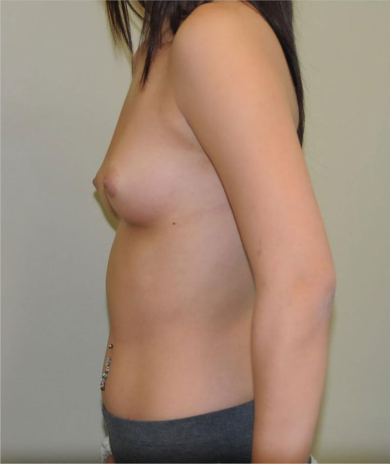 Breast Augmentation Before & After Gallery - Patient 191639433 - Image 3