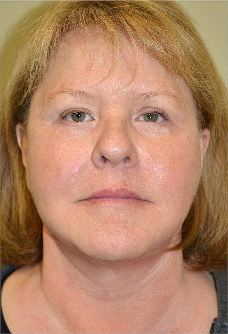 Face and Neck Lifts Before & After Gallery - Patient 191668478 - Image 2