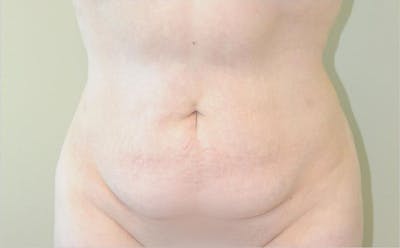 Tummy Tuck Before & After Gallery - Patient 191643440 - Image 1