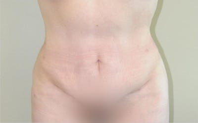 Tummy Tuck Before & After Gallery - Patient 191643440 - Image 2