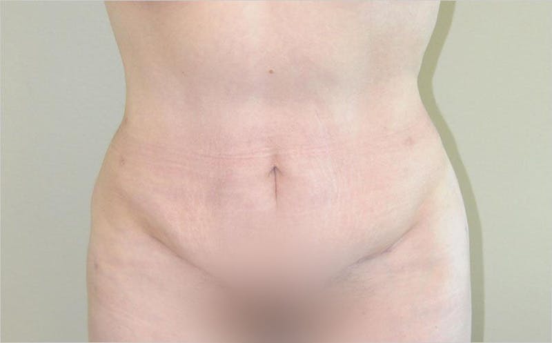 Tummy Tuck Before & After Gallery - Patient 191643440 - Image 2