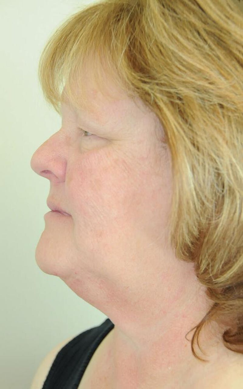 Face and Neck Lifts Before & After Gallery - Patient 191668478 - Image 3