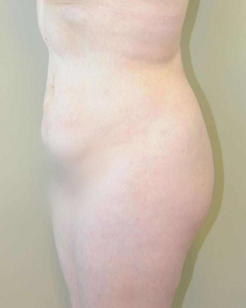 Tummy Tuck Before & After Gallery - Patient 191643440 - Image 3
