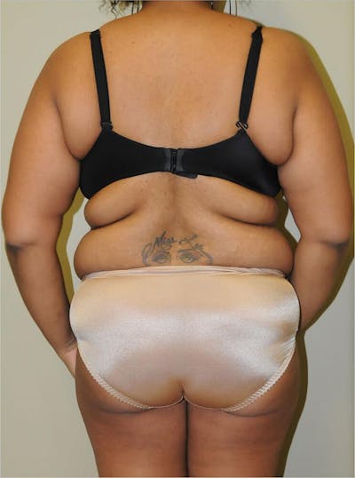 Liposuction Before & After Gallery - Patient 191674640 - Image 1