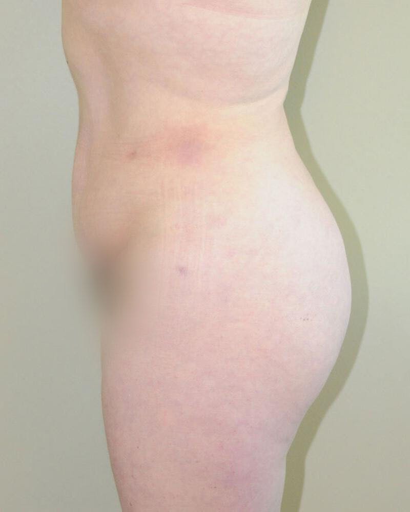 Tummy Tuck Before & After Gallery - Patient 191643440 - Image 4