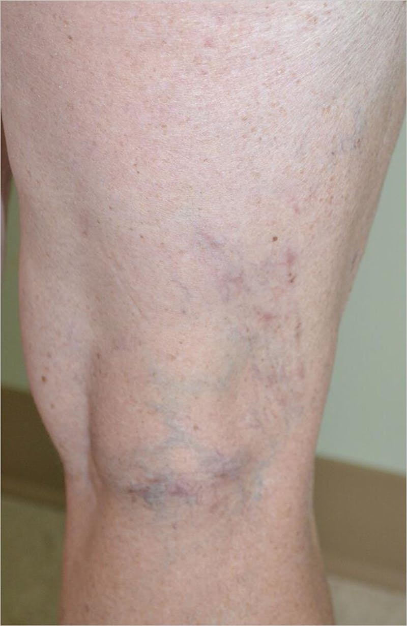 Laser Before & After Gallery - Patient 191674639 - Image 2