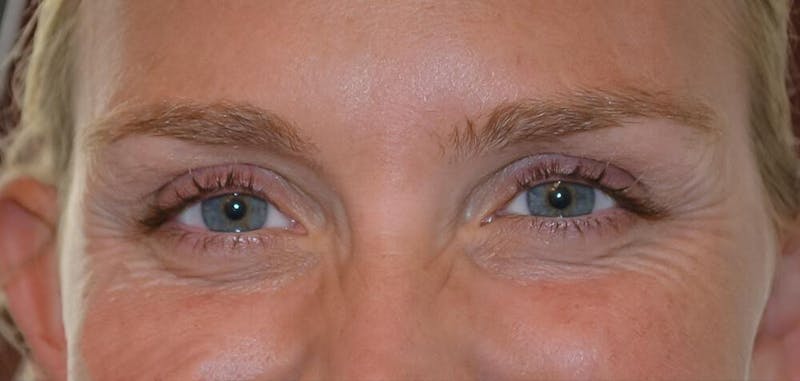 Botox & Dysport Before & After Gallery - Patient 191674602 - Image 1