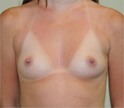 Breast Augmentation Before & After Gallery - Patient 191674642 - Image 1