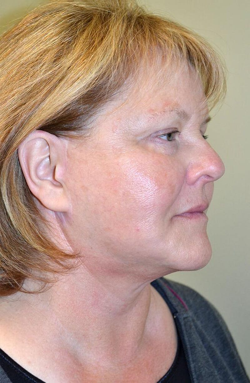 Face and Neck Lifts Before & After Gallery - Patient 191668478 - Image 6