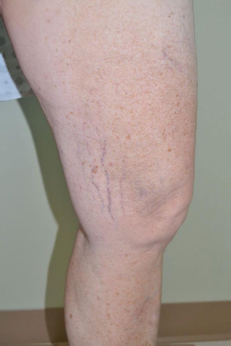 Laser Before & After Gallery - Patient 191674639 - Image 3