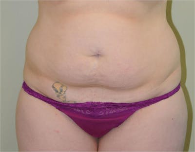 Tummy Tuck Before & After Gallery - Patient 191674644 - Image 1