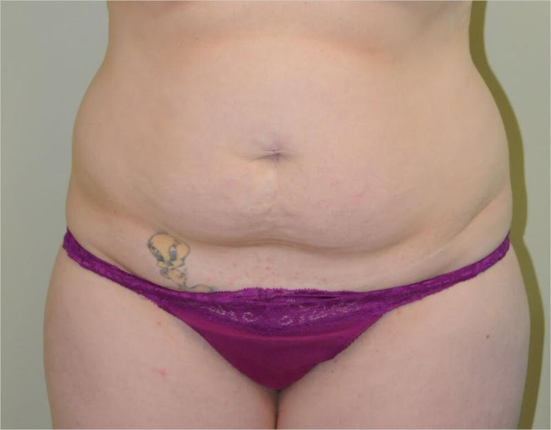 Tummy Tuck Before & After Gallery - Patient 191674644 - Image 1