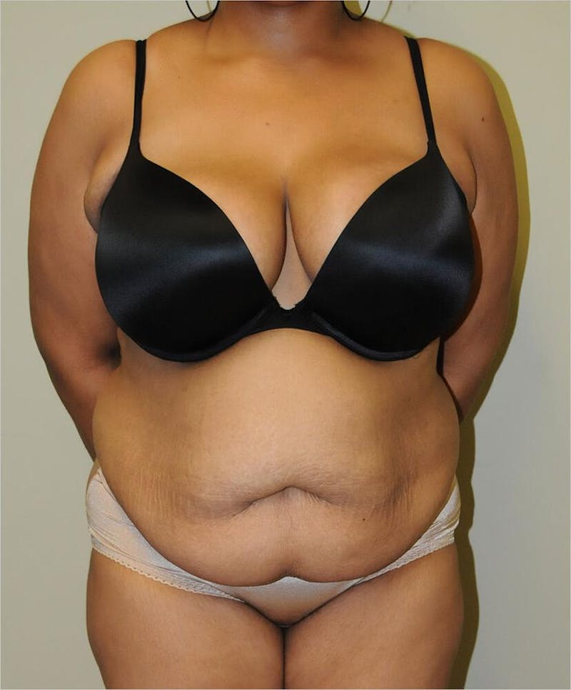 Liposuction Before & After Gallery - Patient 191674640 - Image 3