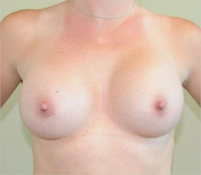 Breast Augmentation Before & After Gallery - Patient 191674642 - Image 2