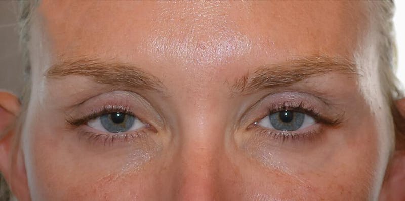 Botox & Dysport Before & After Gallery - Patient 191674602 - Image 2