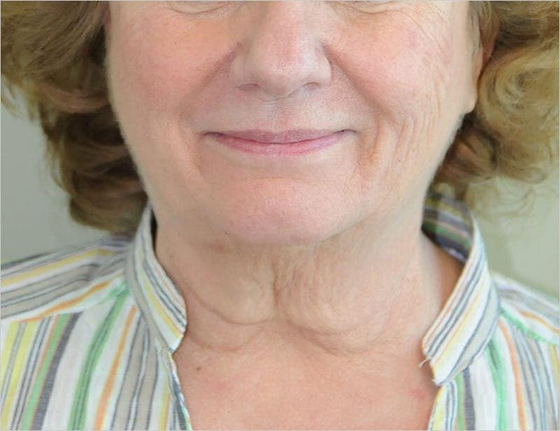 Face and Neck Lifts Before & After Gallery - Patient 191674646 - Image 1