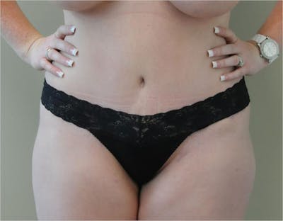 Tummy Tuck Before & After Gallery - Patient 191674644 - Image 2