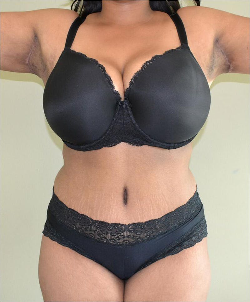Liposuction Before & After Gallery - Patient 191674640 - Image 4