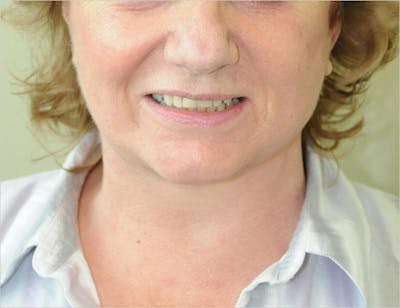 Face and Neck Lifts Before & After Gallery - Patient 191674646 - Image 2