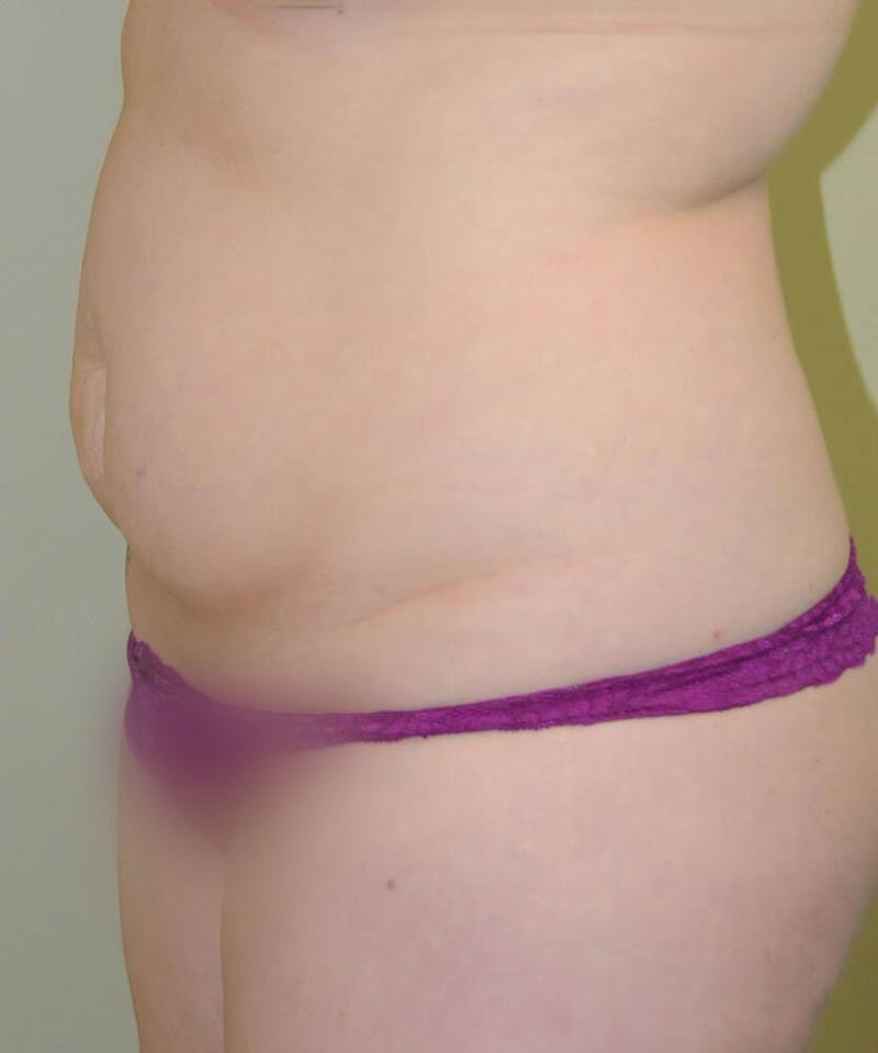 Tummy Tuck Before & After Gallery - Patient 191674644 - Image 3