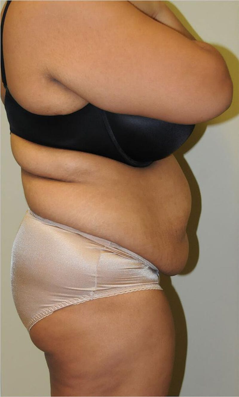 Liposuction Before & After Gallery - Patient 191674640 - Image 5
