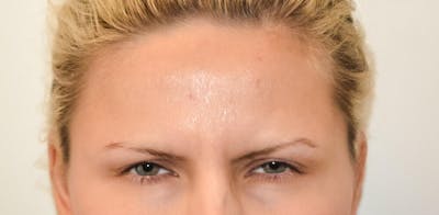 Botox & Dysport Before & After Gallery - Patient 191674641 - Image 2
