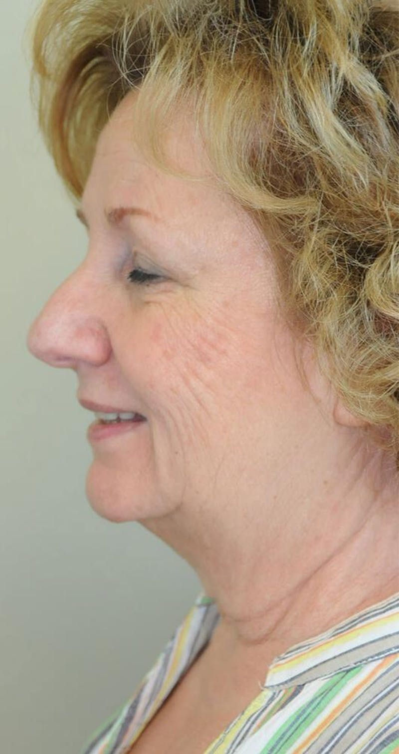 Face and Neck Lifts Before & After Gallery - Patient 191674646 - Image 3