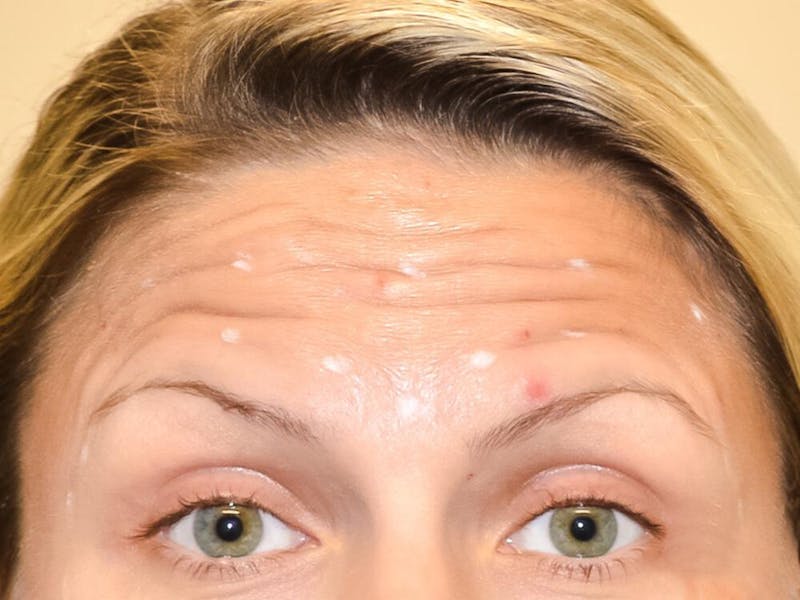 Botox & Dysport Before & After Gallery - Patient 191674641 - Image 3