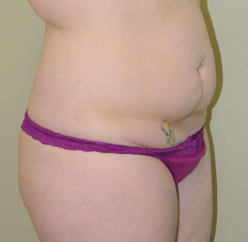Tummy Tuck Before & After Gallery - Patient 191674644 - Image 5
