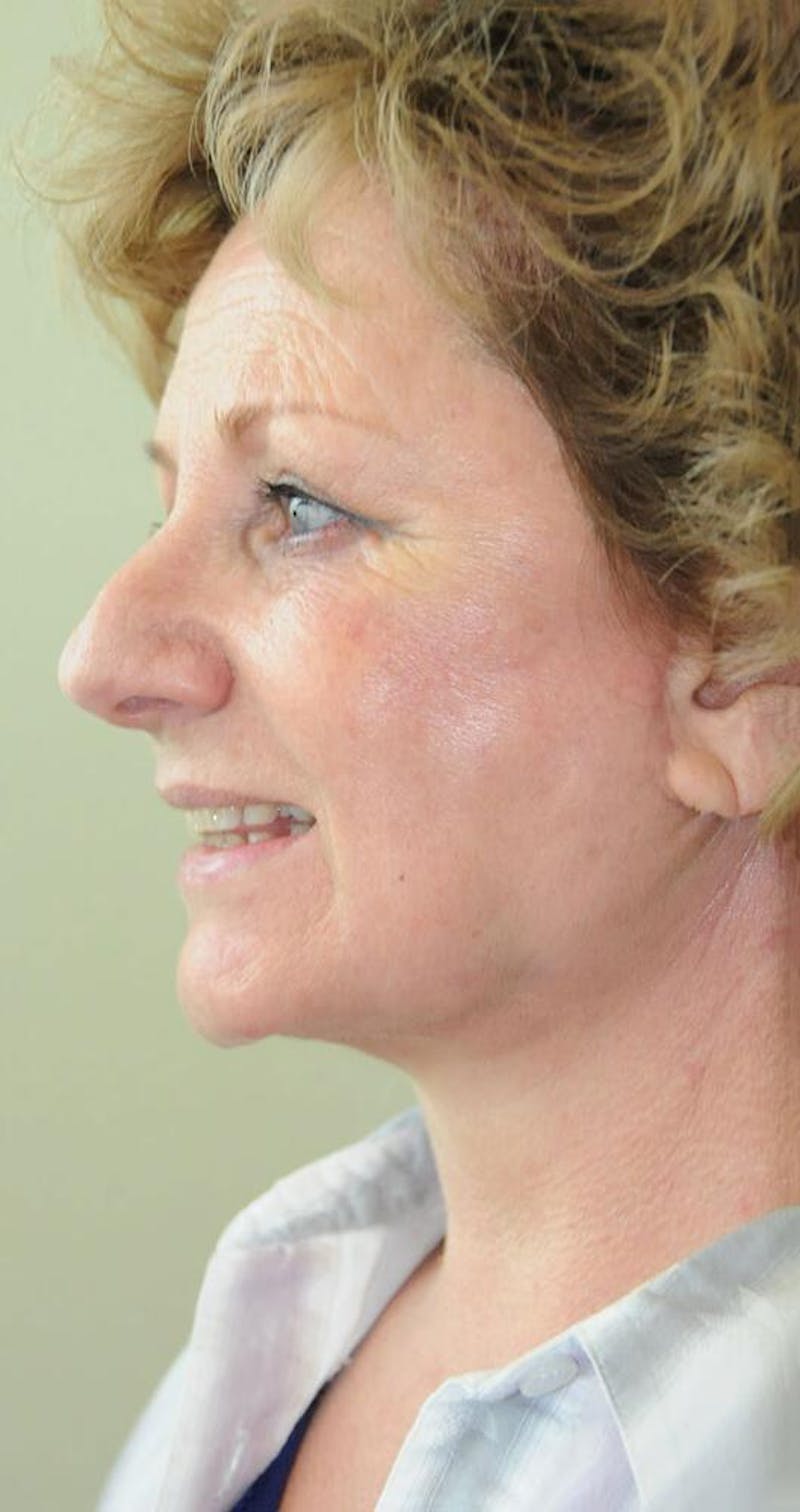 Face and Neck Lifts Before & After Gallery - Patient 191674646 - Image 4