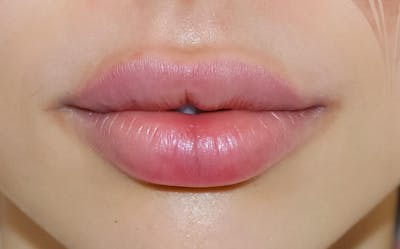 Fillers Before & After Gallery - Patient 191674643 - Image 2