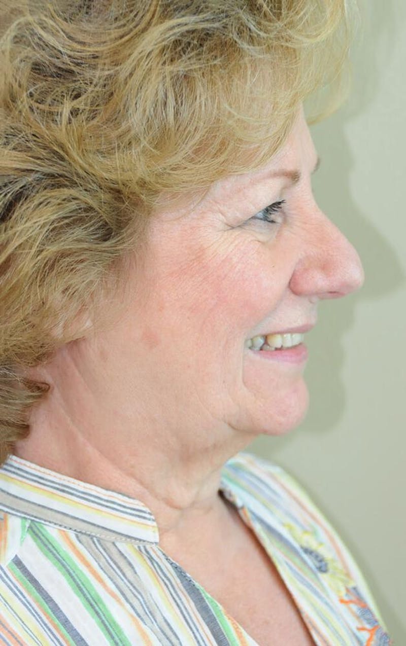 Face and Neck Lifts Before & After Gallery - Patient 191674646 - Image 5