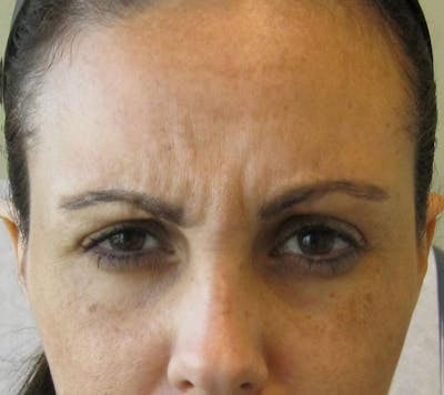 Botox & Dysport Before & After Gallery - Patient 191674648 - Image 1