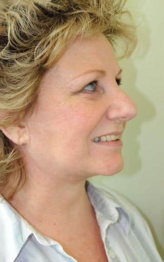 Face and Neck Lifts Before & After Gallery - Patient 191674646 - Image 6