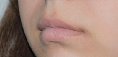 Fillers Before & After Gallery - Patient 191674647 - Image 1