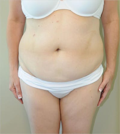 Tummy Tuck Before & After Gallery - Patient 191674653 - Image 1