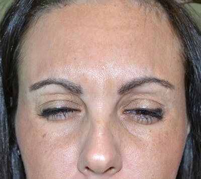 Botox & Dysport Before & After Gallery - Patient 191674648 - Image 2