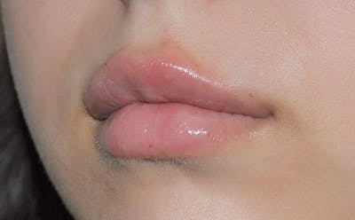 Fillers Before & After Gallery - Patient 191674647 - Image 2