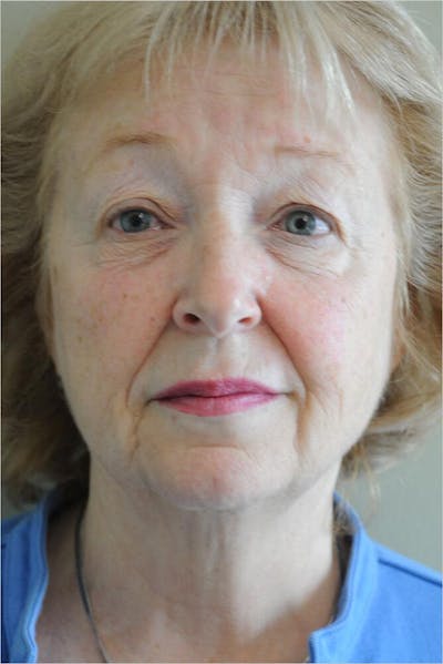 Face and Neck Lifts Before & After Gallery - Patient 191674656 - Image 1