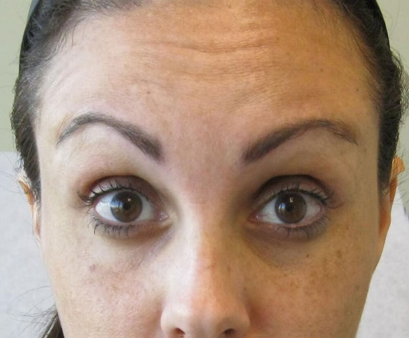 Botox & Dysport Before & After Gallery - Patient 191674648 - Image 3