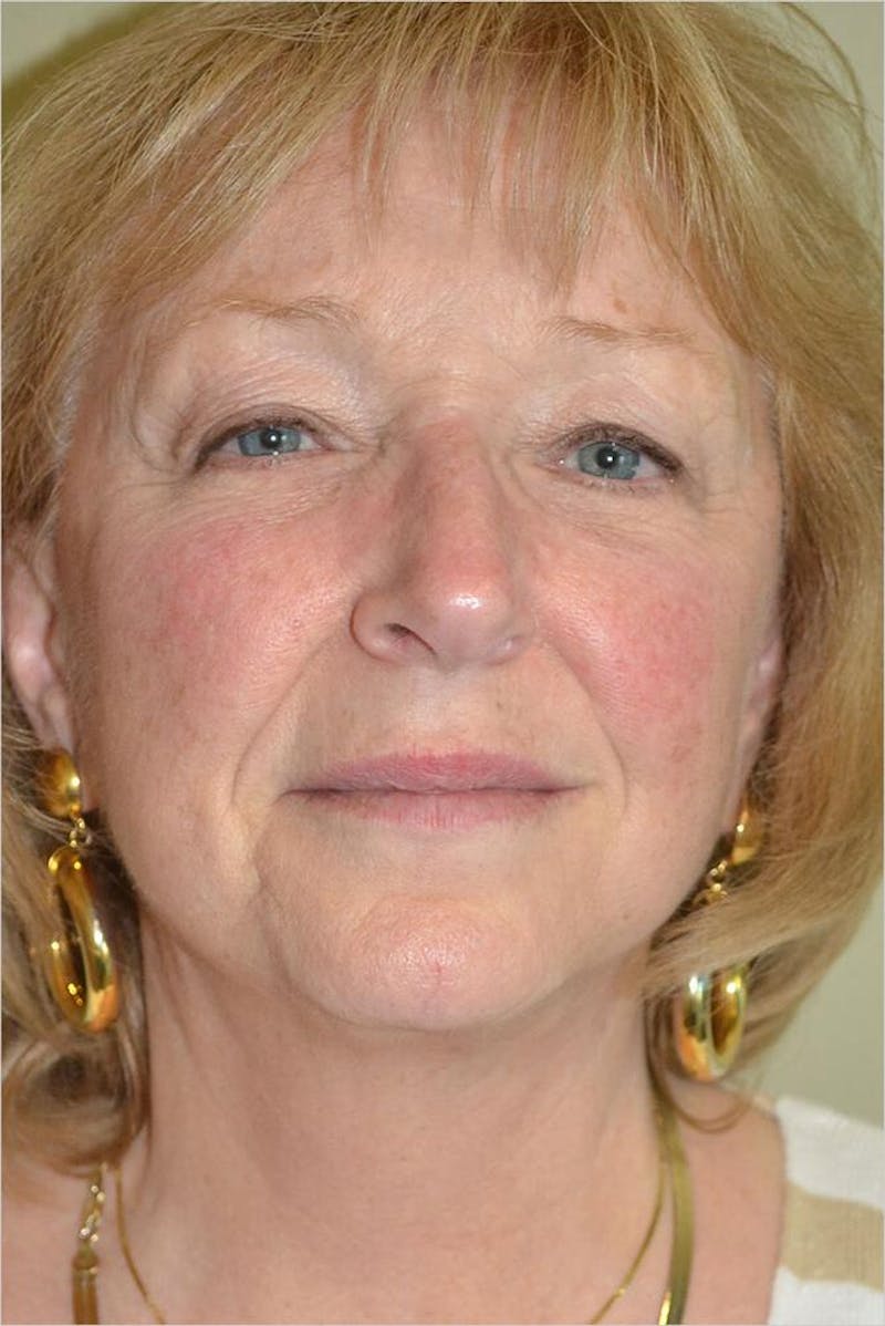 Face and Neck Lifts Before & After Gallery - Patient 191674656 - Image 2
