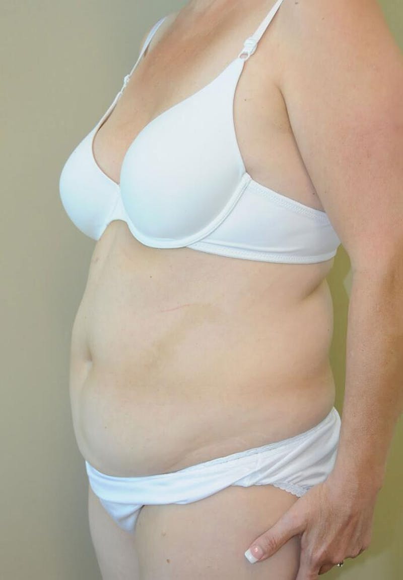 Tummy Tuck Before & After Gallery - Patient 191674653 - Image 3