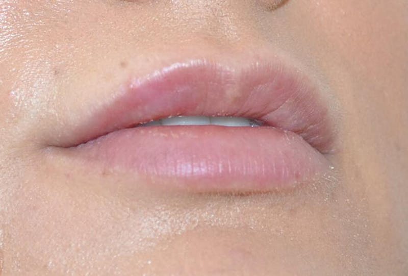 Fillers Before & After Gallery - Patient 191674649 - Image 1