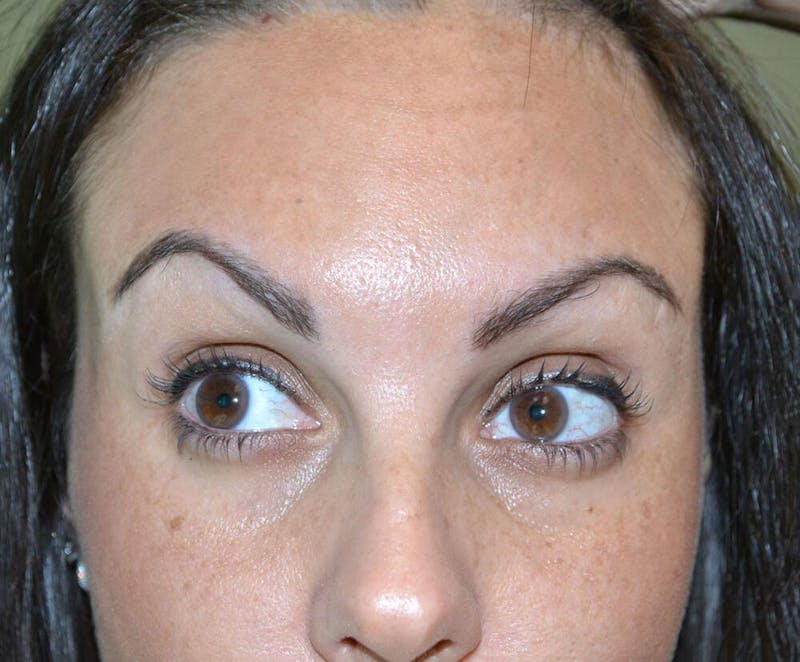 Botox & Dysport Before & After Gallery - Patient 191674648 - Image 4