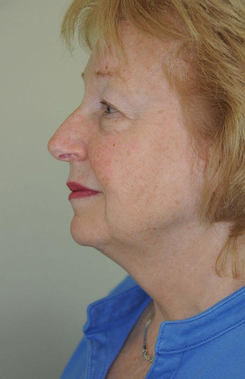 Face and Neck Lifts Before & After Gallery - Patient 191674656 - Image 3